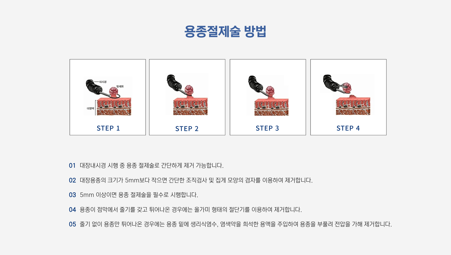 용종절제술2.png